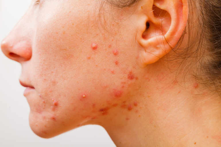 fiche_maladie_acne_gallerylarge